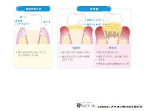 歯周病